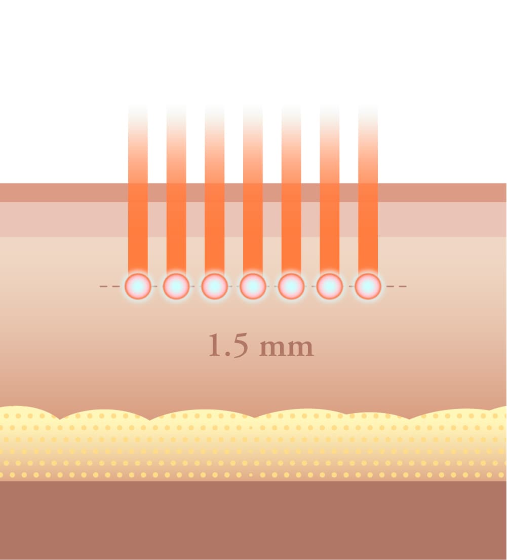 Sofwave — Beyond traditional lifting limits