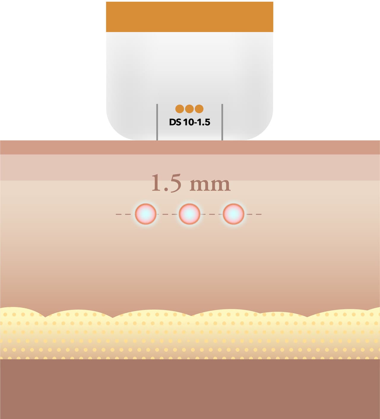 Ulthera tips and energy settings adjusted per patient at DA Dermatology Dosan